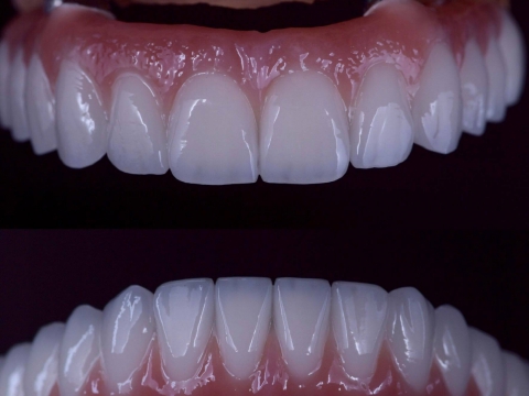 Răng sứ trên IMPLANT