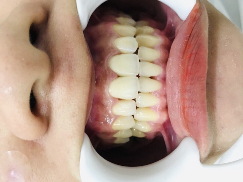 Răng sứ tiệp màu và hoàn chỉnh như răng thật