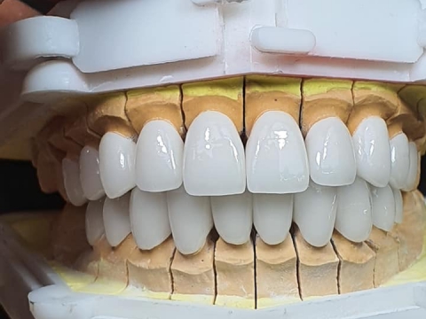 Răng sứ phom răng vuông _mạnh mẽ