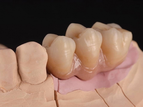 Cầu implant